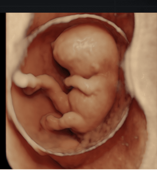 bb-9-semanas | Clínica Miraflores | Ginecología y Fertilidad